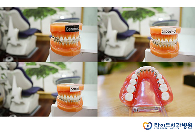 돌출입교정, 돌출입 콤플렉스를 벗어나는 방법 관련 이미지 5