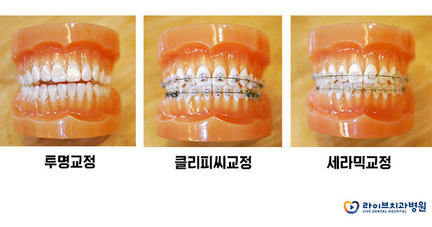 앞니부분교정, 모든 궁금증 타파! 관련 이미지 3