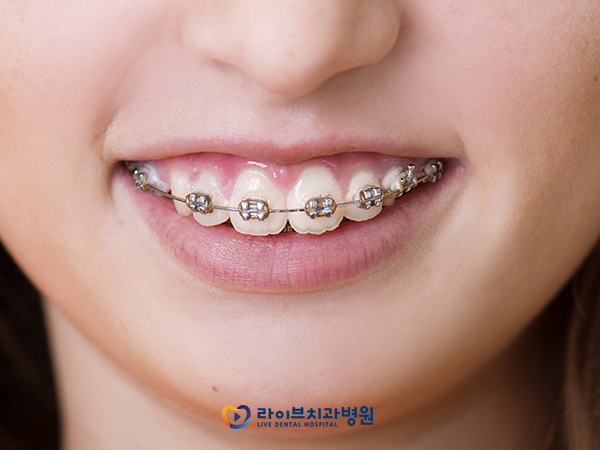 교정월치료, 정기적인 내원이 필요한 이유는? 관련 이미지 3