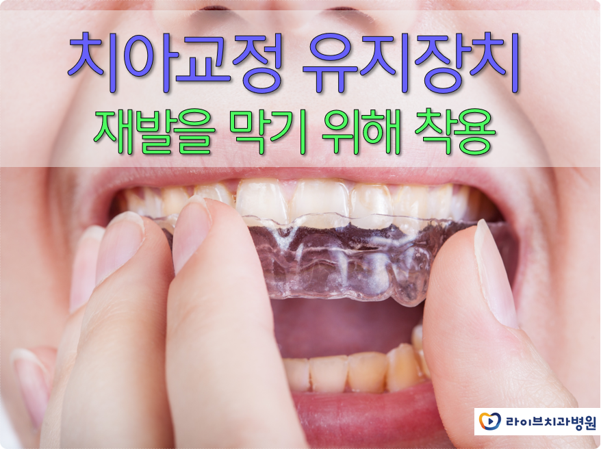 치아교정 유지장치 재발을 막기 위해 착용 관련 이미지 1