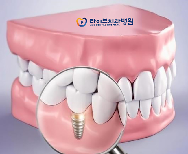 임플란트, 부작용은 없을까? 관련 이미지 2