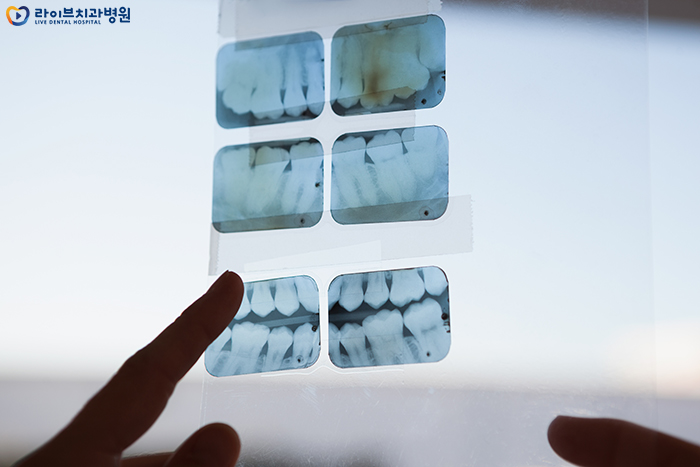 임플란트 과정 미리 알아두고 치료받자 관련 이미지 3