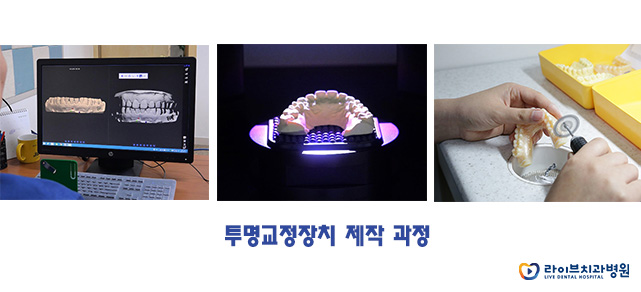 투명교정 대상과 장점은? 관련 이미지 6