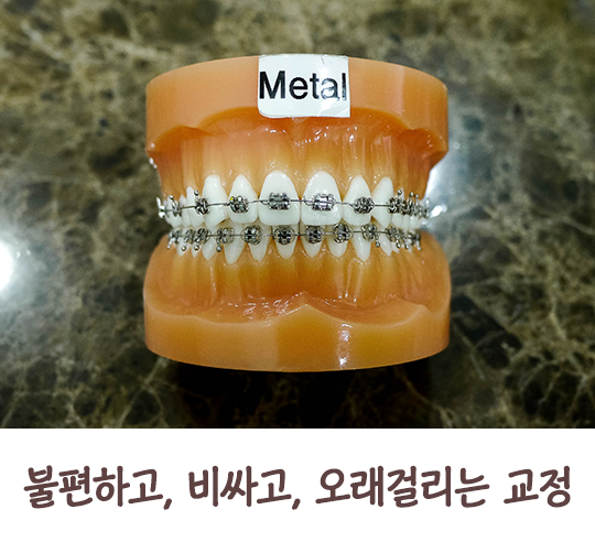 부분교정으로 편하게 교정하자! 관련 이미지 2