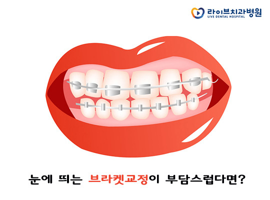 투명교정, 그대 심미성 걱정하지 말아요~ 관련 이미지 2