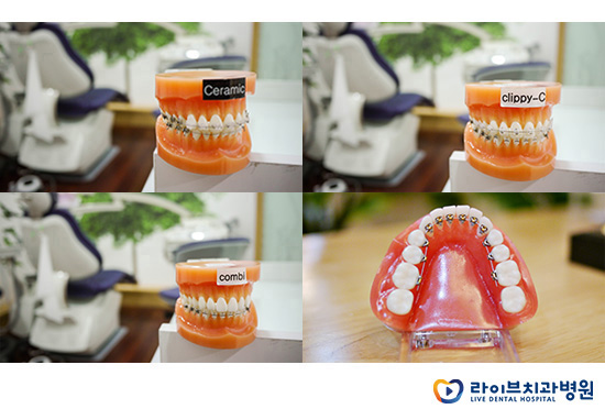 치아교정비용, 그 합리적인 기준을 찾아서 관련 이미지 4