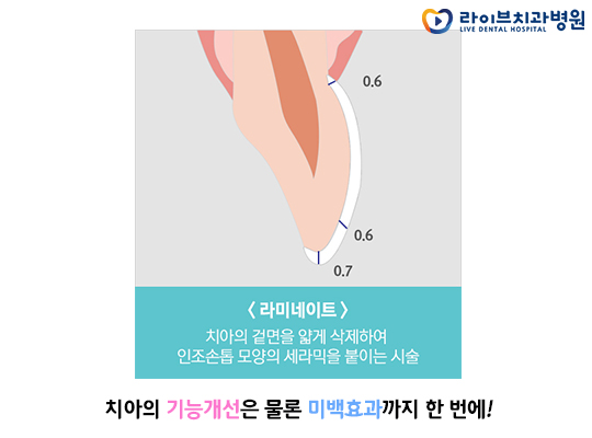 앞니라미네이트, 치아성형으로 자신감 회복! 관련 이미지 3