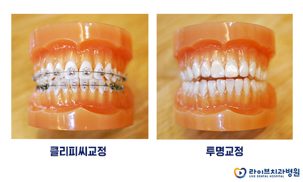 앞니부분교정으로 자신있게 스마일! 관련 이미지 3