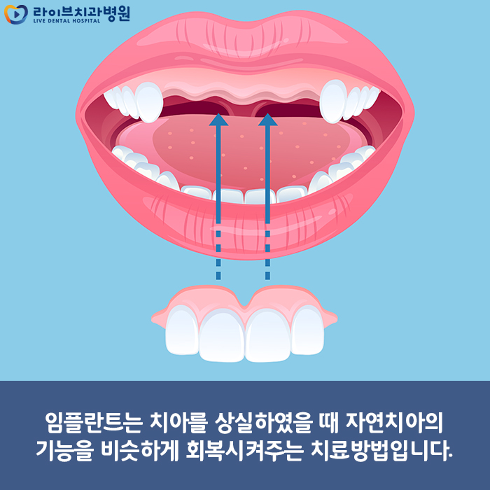 임플란트 과정 미리 알아두고 치료받자 관련 이미지 2