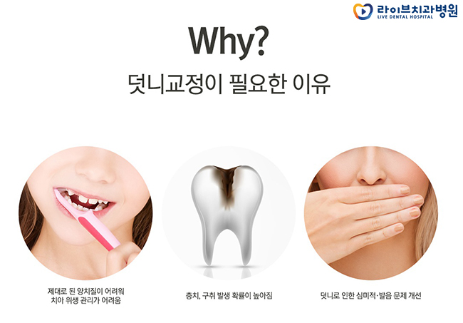 덧니교정 왜 필요한가? 관련 이미지 2