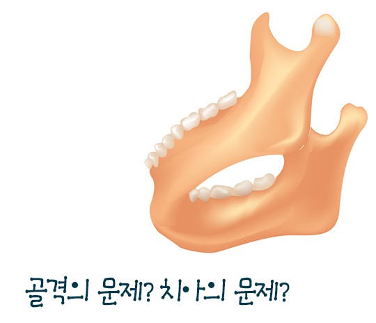 안면비대칭은 왜 생기고 어떻게 치료할까? 관련 이미지 5