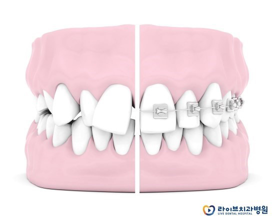 교정기종류, 무엇을 어떻게 선택해야 할까? 관련 이미지 2