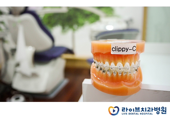 교정기의 다양한 종류를 알아보자! 관련 이미지 5