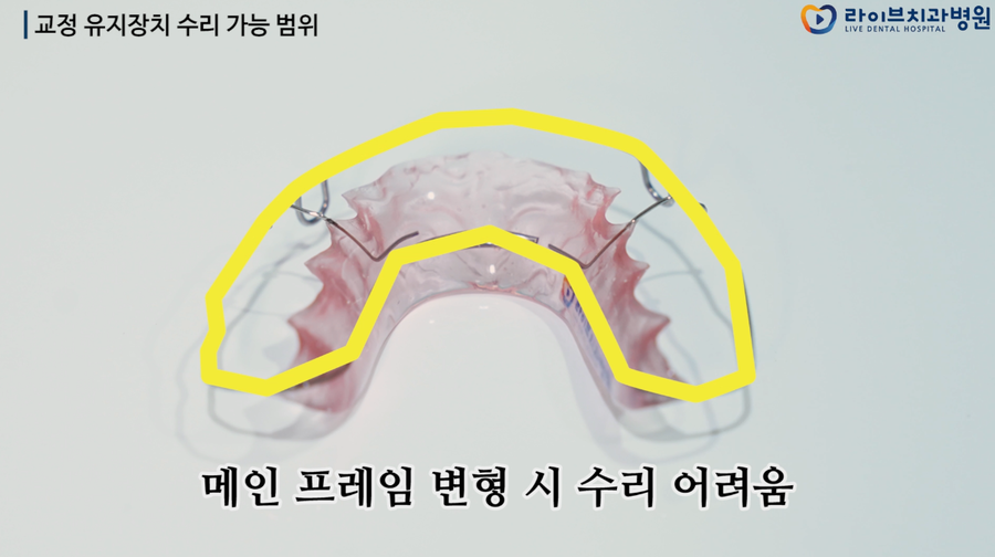교정장치의 종류와 내구성 그리고 유지장치의 수리 가능 범위 관련 이미지 1