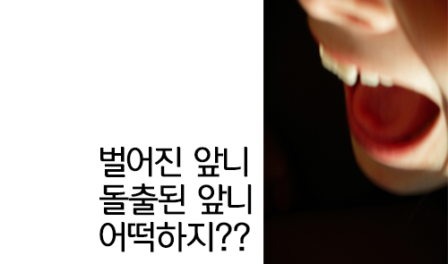 앞니교정, 그것은 무엇인가? 관련 이미지 4