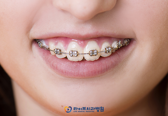 세라믹교정, 어떤 장점들이 있을까요? 관련 이미지 2