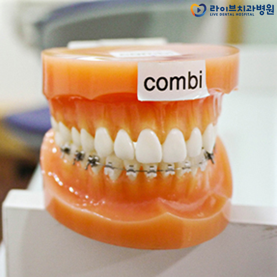 치아교정방법 어떤 방법으로 해야할까요? 관련 이미지 7