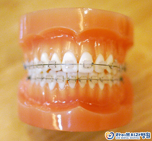 세라믹교정 어떤 점이 좋을까요? 관련 이미지 3