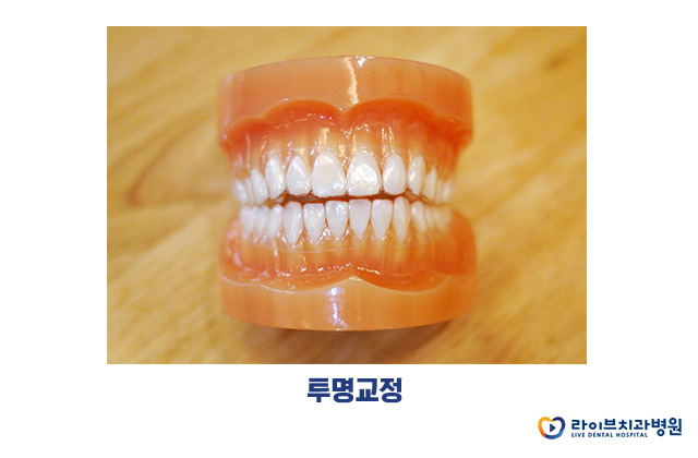 투명교정, 합리적으로 예쁘게! 관련 이미지 2