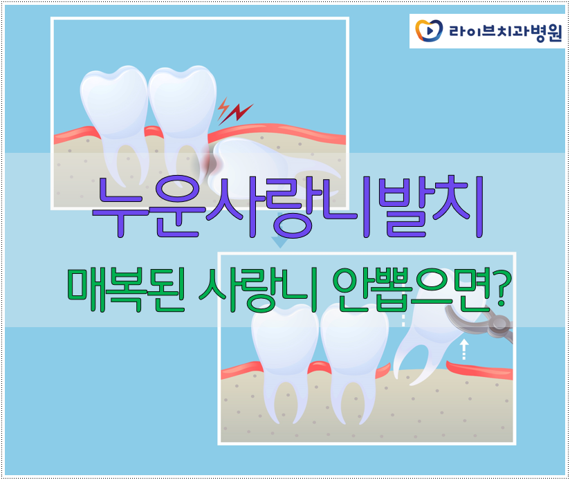 누운사랑니발치 매복된 사랑니 안뽑으면 안될까? 관련 이미지 1