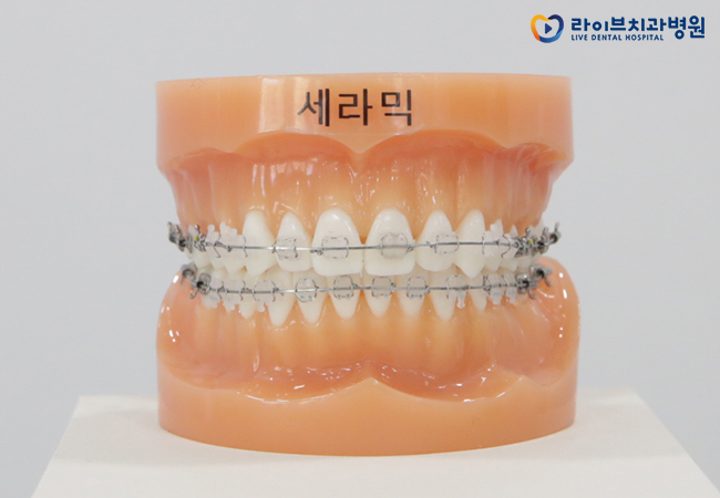 앞니부분교정, 내게도 적합한 치료일까? 관련 이미지 4