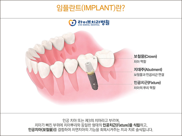 어금니임플란트 망설이지 마세요! 관련 이미지 2