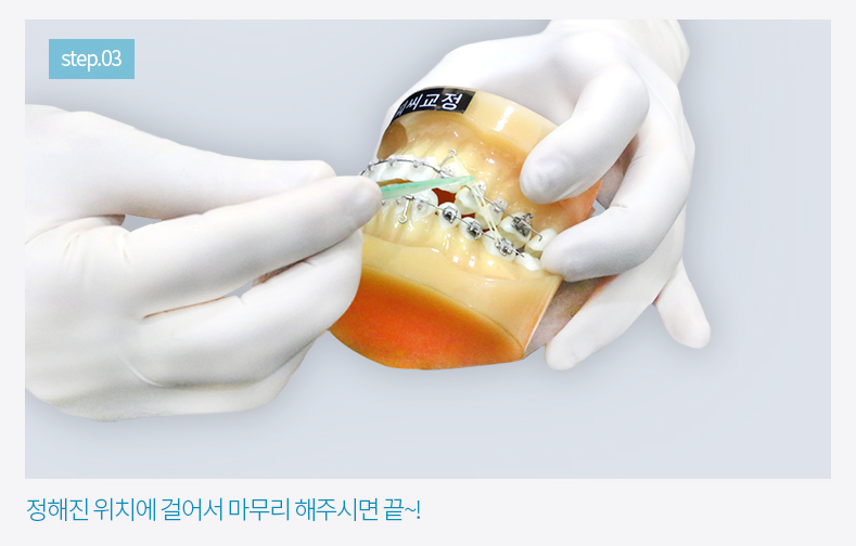 치아교정 고무줄 어렵지 않아요. (feat.영상설명) 관련 이미지 5