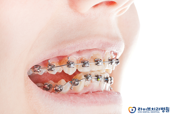 앞니교정 부담없이 받기 위해선? 관련 이미지 4