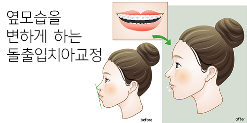돌출입치아교정의 진행 과정과 효과에 대해! 관련 이미지 2