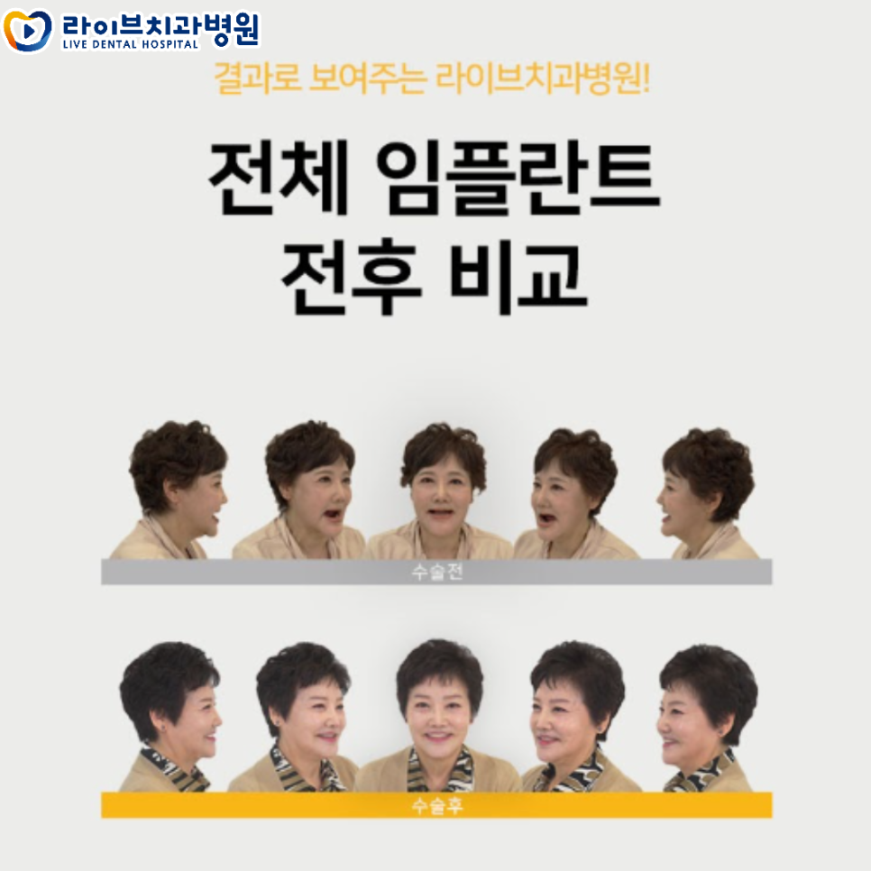 라이브치과병원 리얼스토리 전후 사진! 관련 이미지 4