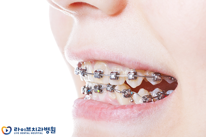 교정장치 떨어짐 어떻게 해야하죠? 관련 이미지 2