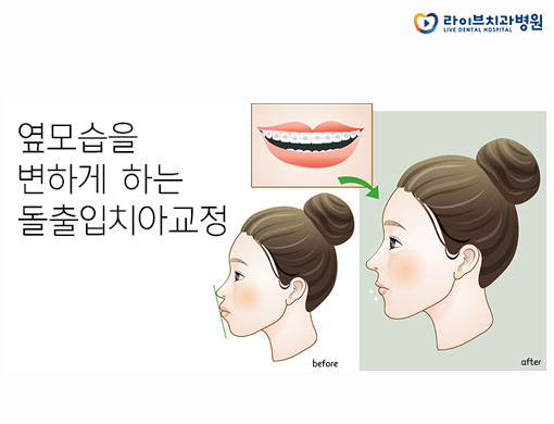 돌출입치아교정, 유지관리가 정말 중요해요! 관련 이미지 2
