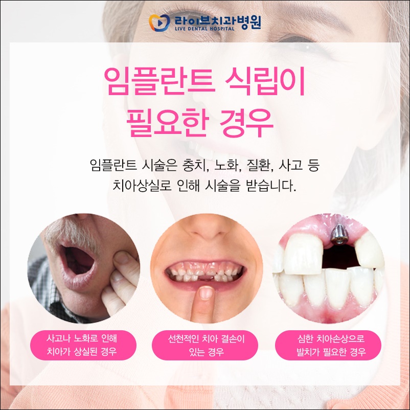 임플란트재수술 선택을 앞두고 있다면? 관련 이미지 2