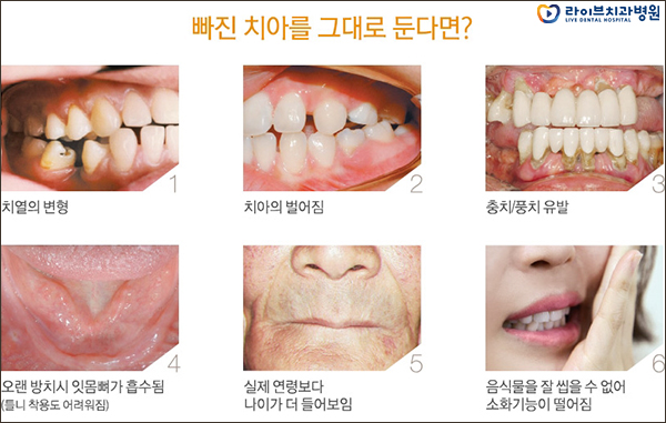어금니임플란트 망설이지 마세요! 관련 이미지 4