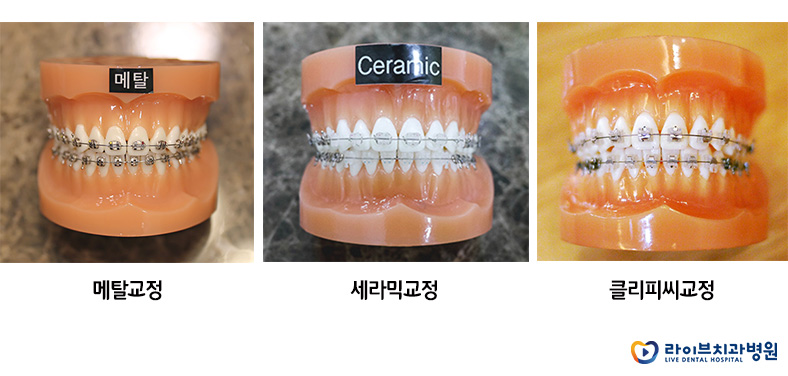 치아교정방법, 나에게 맞는 방법은 무엇일까? 관련 이미지 3
