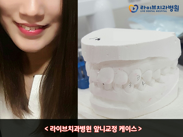 앞니교정 잘하는 강남역치과 어디? 관련 이미지 5