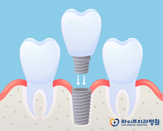 인천임플란트, 꼼꼼히 따져보고 결정하세요(: 관련 이미지 2