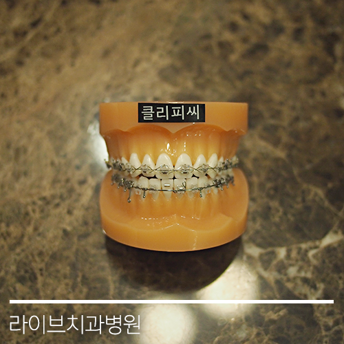 다양한 교정기의 종류들! 관련 이미지 5