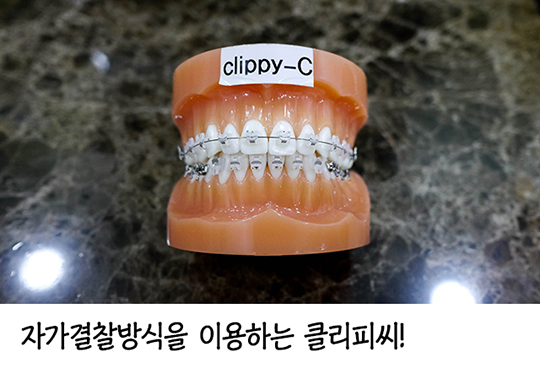 클리피씨교정, 기간 때문에 교정을 고민하시나요? 관련 이미지 4
