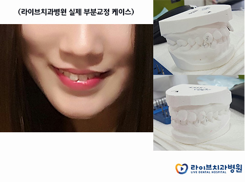 앞니부분교정, 모든 궁금증 타파! 관련 이미지 2