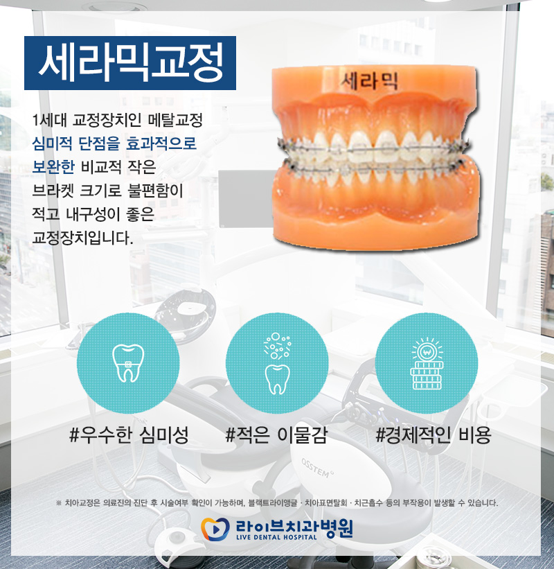 치아교정기종류 어디까지 알고있니 관련 이미지 3