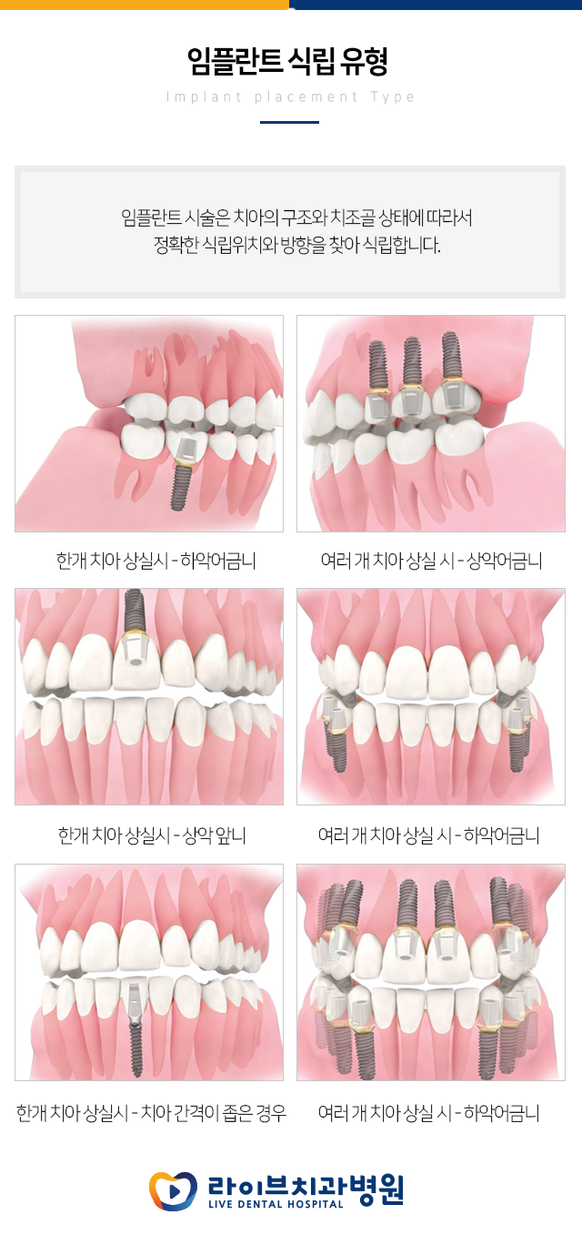 임플란트 재시술 받기 전에 잘 관리하자!!! 관련 이미지 4