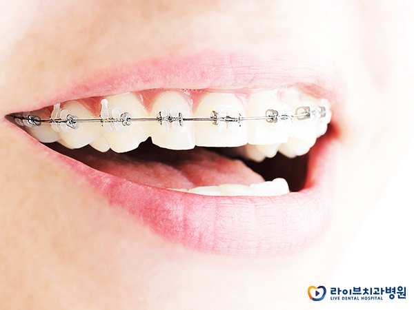 겨울방학 치아교정, 어디서 하는 것이 좋을까? 관련 이미지 2