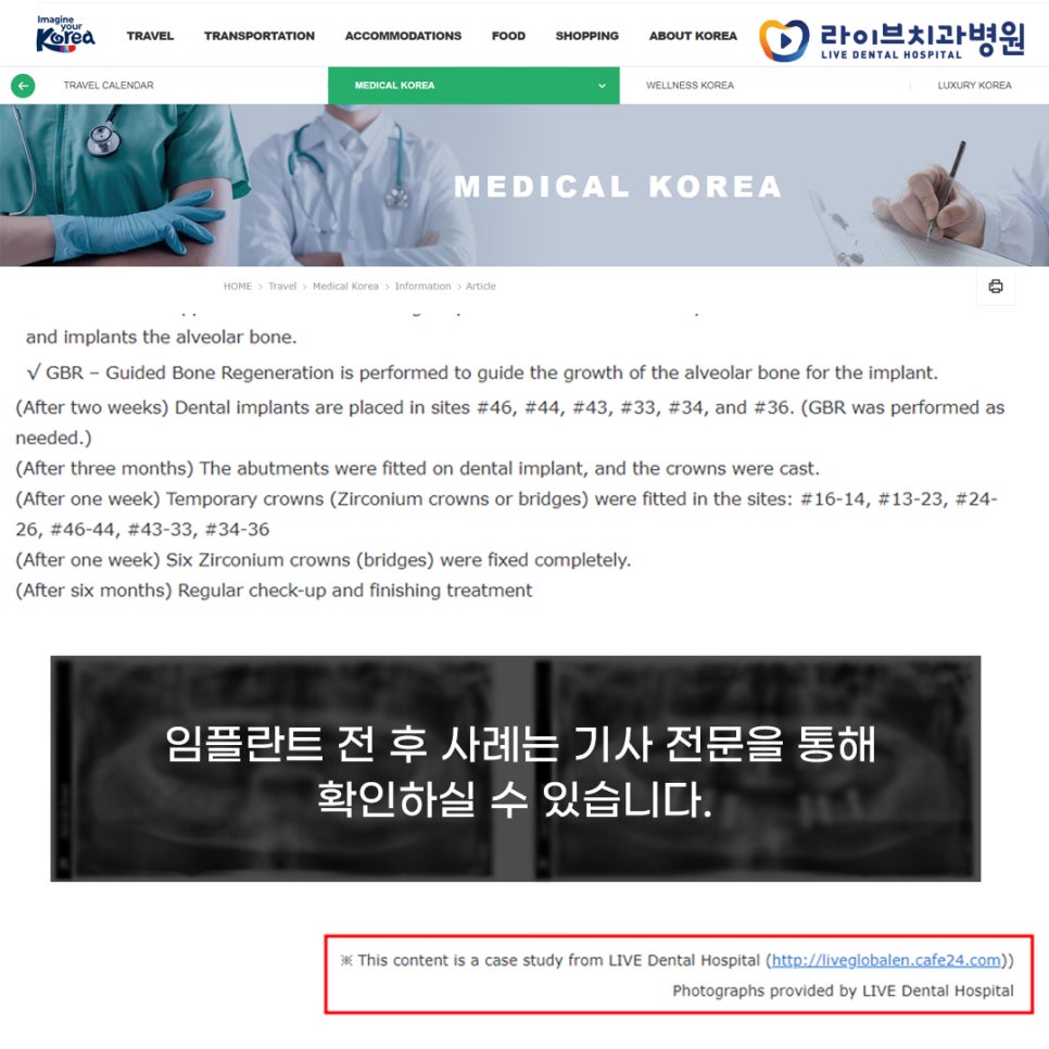 한국관광공사 홈페이지에 라이브치과 환자 사례 기사 기재! 관련 이미지 1