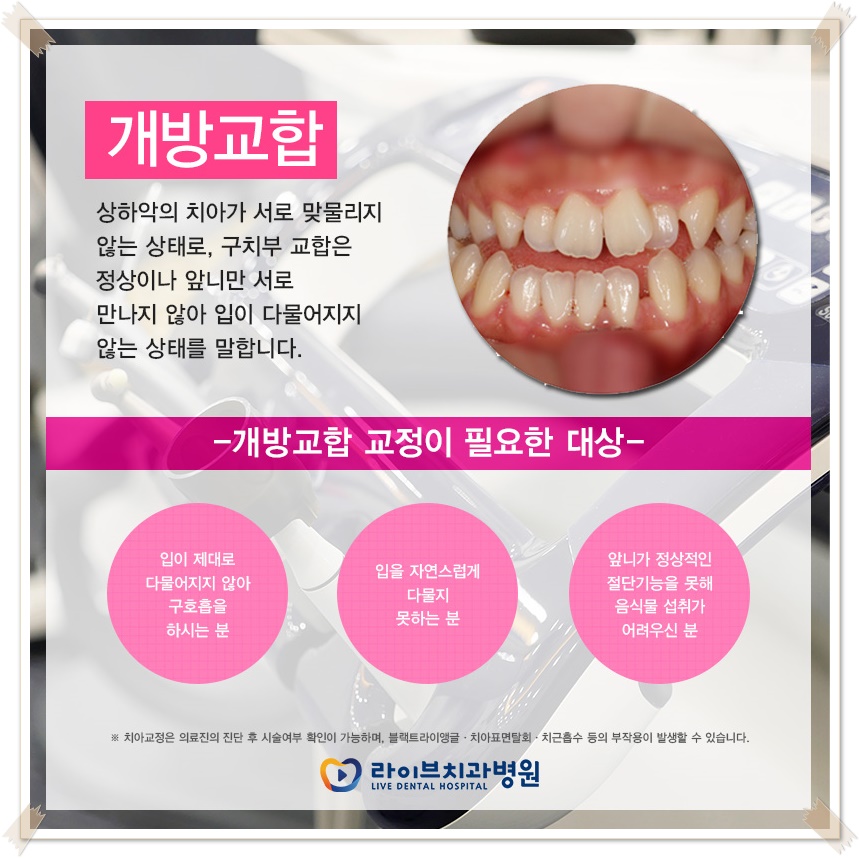 치아교정종류 상황에 맞게! 관련 이미지 4