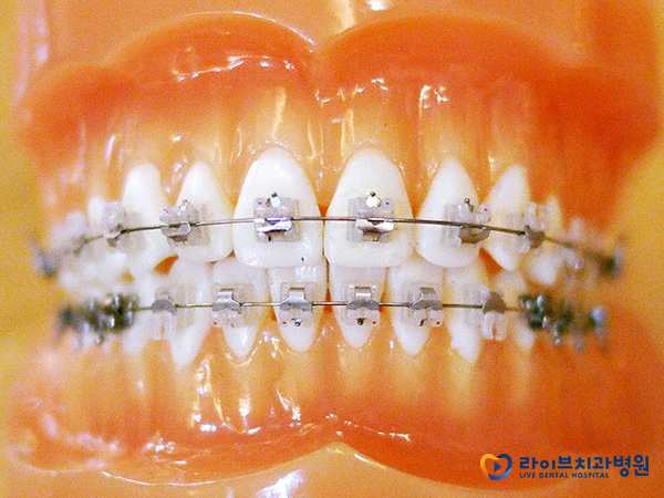 클리피씨교정, 정말 치료기간 단축이 가능할까? 관련 이미지 4