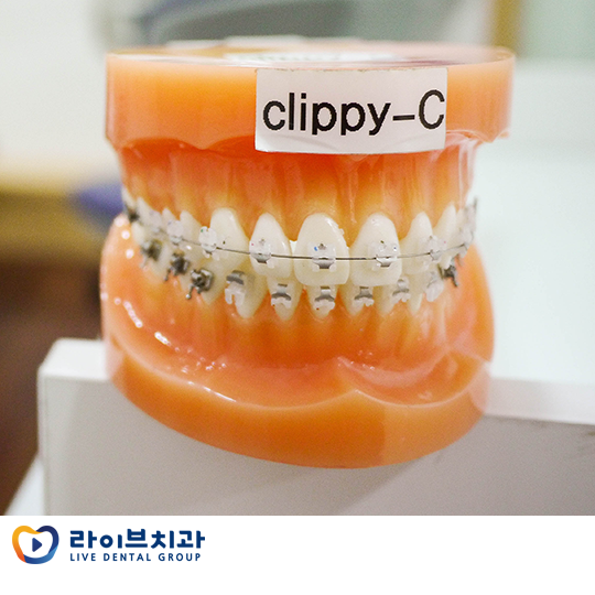 치아교정, 종류는 어떤 것들이 있을까? 관련 이미지 5