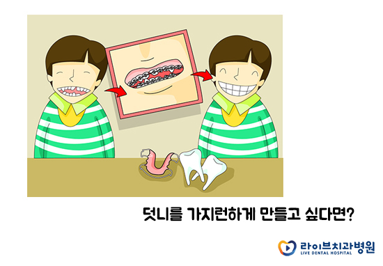 덧니교정, 정말 발치가 필수일까요? 관련 이미지 2