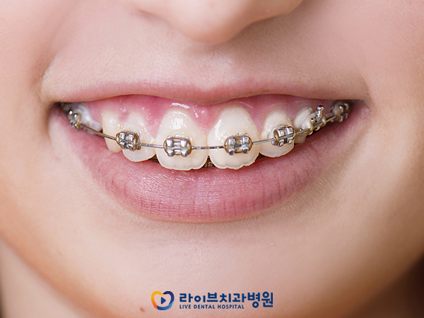 치아교정(: 브라켓 탈락 시 대처방법은? 관련 이미지 2