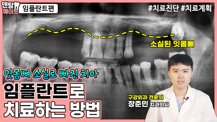 치아 대부분이 상실되었을 때 임플란트로 치료하는 방법[만성치주염, 잇몸뼈이식, 임플란트케이스] 관련 이미지 1